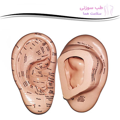  استفاده از نقاط طب سوزنی گوش برای درمان بسیاری از بیماری‌ها