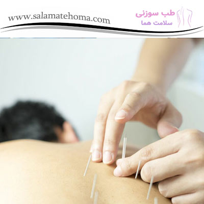 استفاده از طب سوزنی برای درمان کمردرد