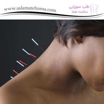 تاثیر طب سوزنی در درمان درد گردن