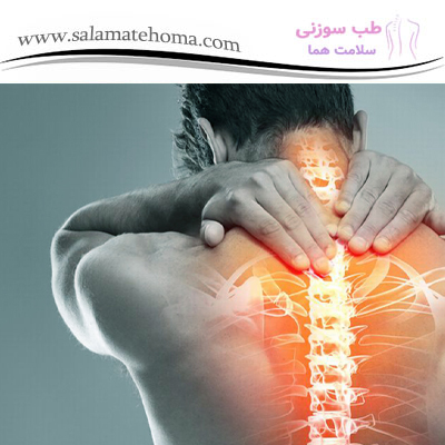  تاثیر طب سوزنی در درمان درد گردن