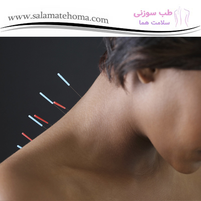 تأثیر طب سوزنی بر عملکرد روزمره افراد با درد گردن