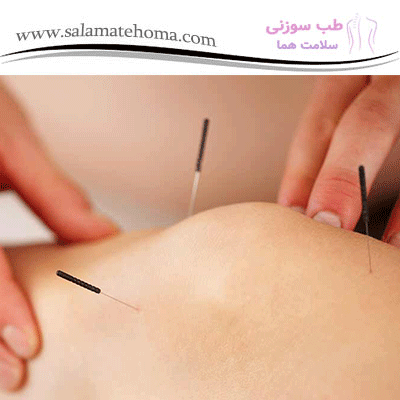 طب سوزنی و کاهش دردهای مربوط به مشکلات گوارشی