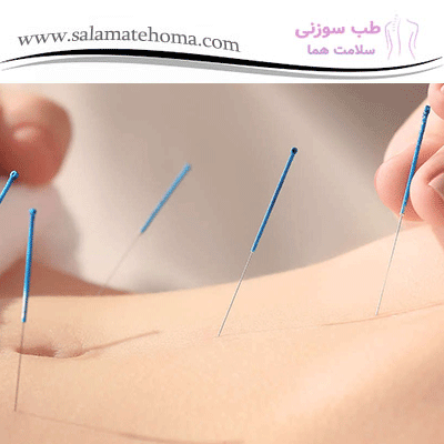 معجزه طب سوزنی در کاهش چربی ‌های شکمی