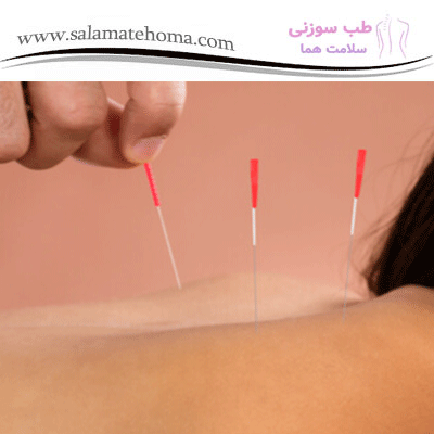 تاثیرات آرامش ‌بخش طب سوزنی بر خواب شبانه