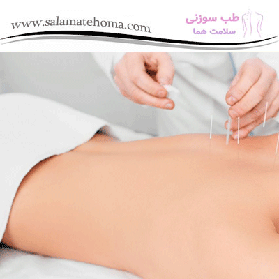 تاثیرات آرامش ‌بخش طب سوزنی بر خواب شبانه