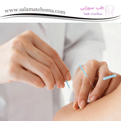  طب سوزنی و تاثیر آن بر متابولیسم بدن و کاهش وزن