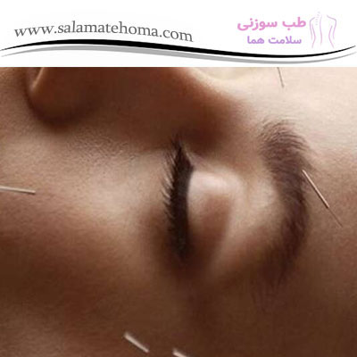 طب سوزنی برای کنترل آکنه