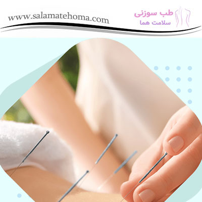  طب سوزنی، روشی طبیعی برای حفظ تناسب اندام