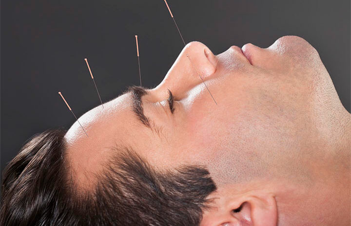  طب سوزنی برای استرس و اضطراب